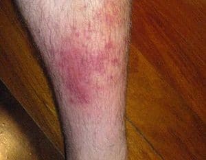 Bacterial skin infections in older adults – don’t make a rash diagnosis